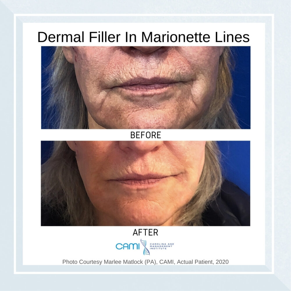 Dermal Fillers case #71093