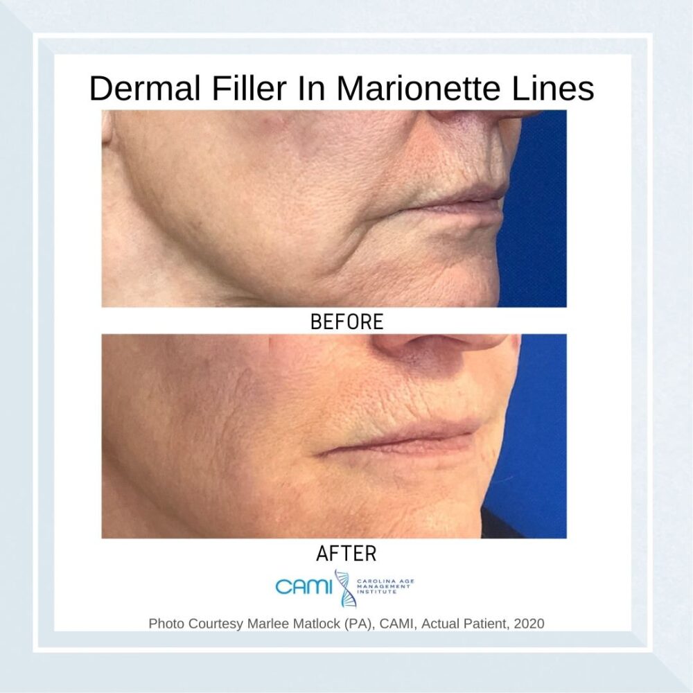 Dermal Fillers case #71092