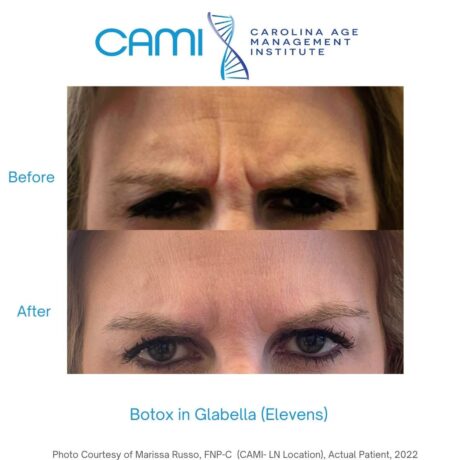 Botox® case #71083