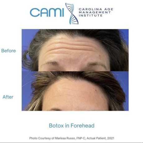 Botox® case #71081