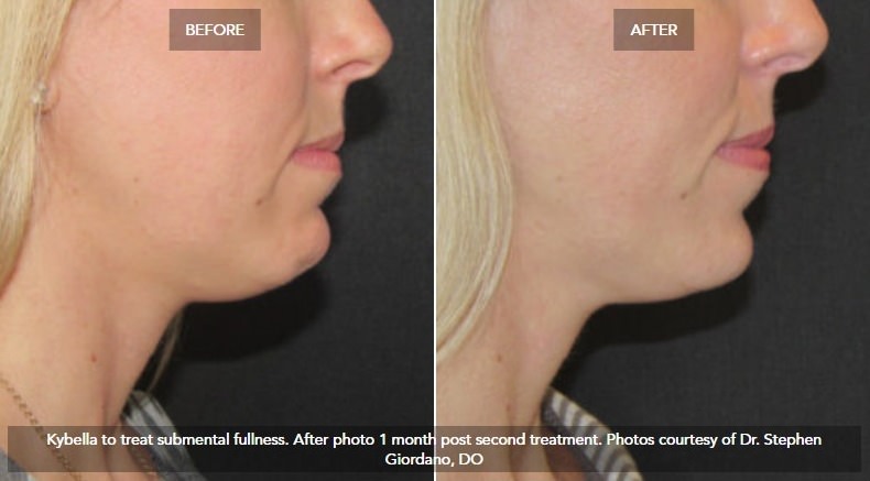 Kybella® case #71145