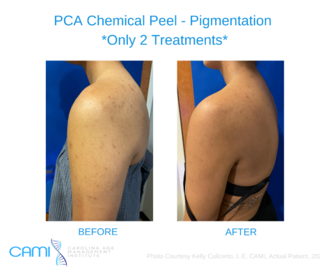 Chemical Peels case #71159