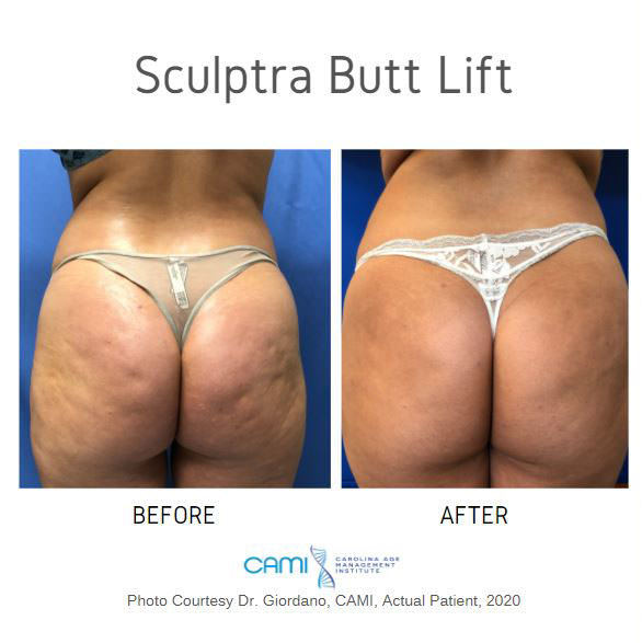 Sculptra® case #71150