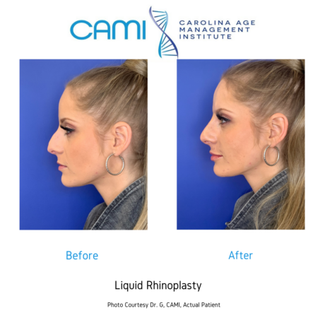 Liquid Rhinoplasty case #71102