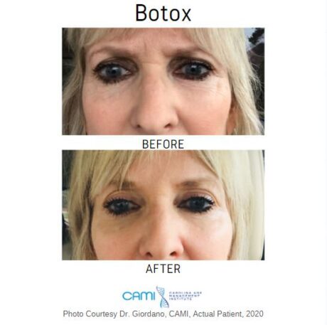 Botox® case #71077