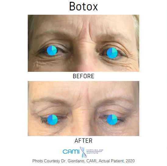 Botox® case #71079