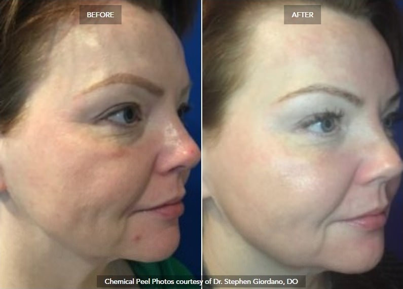 Chemical Peels case #71162