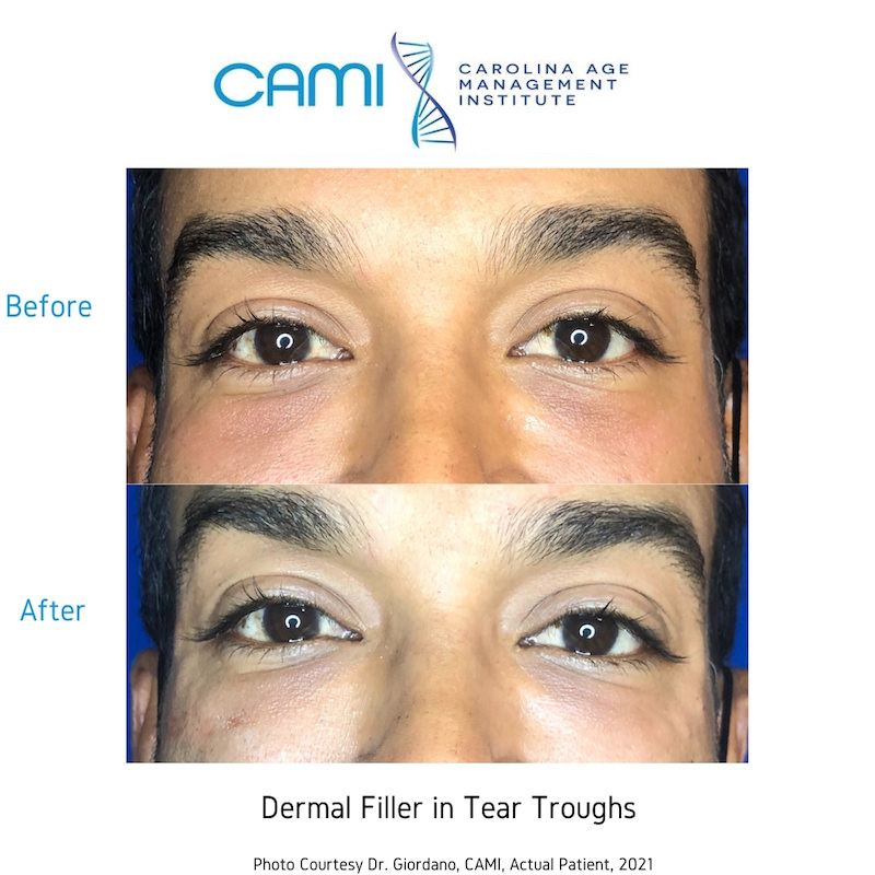 Dermal Fillers case #71132