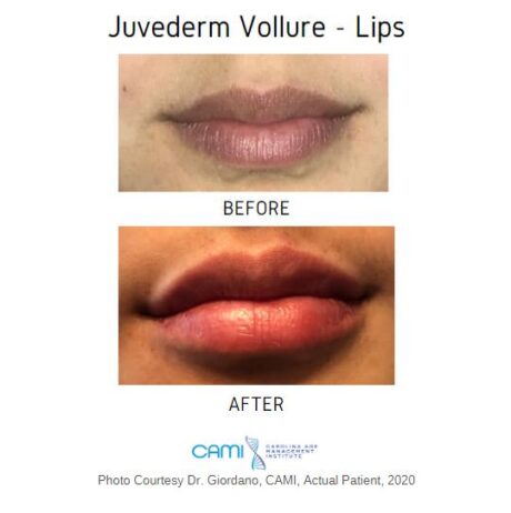 Lip Fillers case #71124