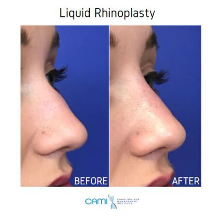 Liquid Rhinoplasty case #71097