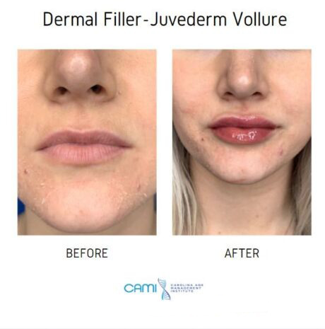 Lip Fillers case #71126