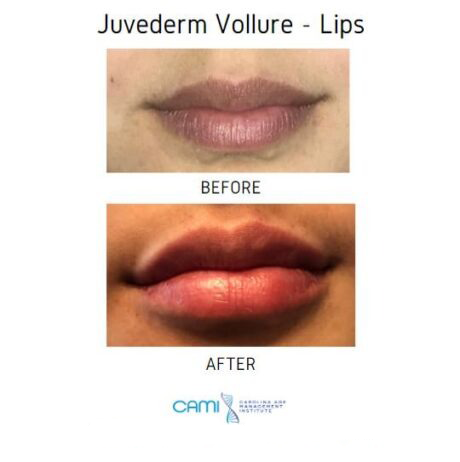 Lip Fillers case #71124