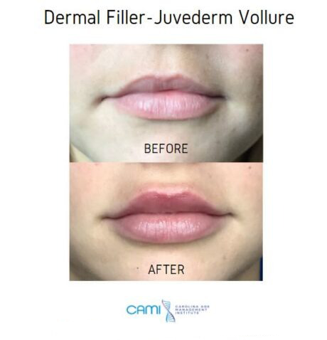 Lip Fillers case #71123