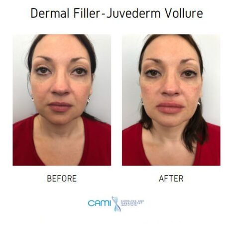 Lip Fillers case #71112