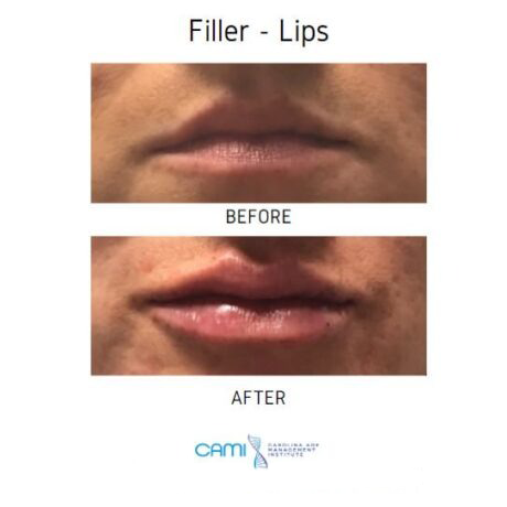 Lip Fillers case #71110