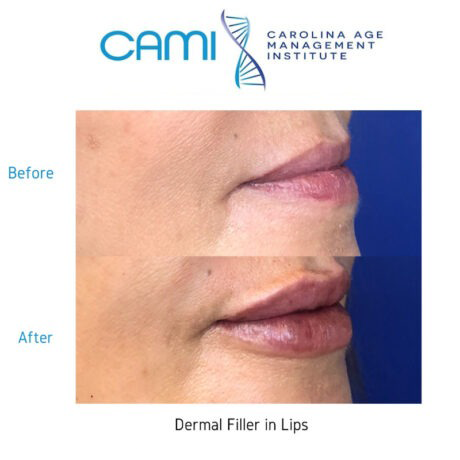 Lip Fillers case #71105