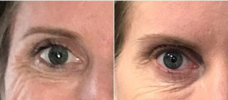 Dysport® case #71134