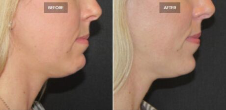 Kybella® case #71145