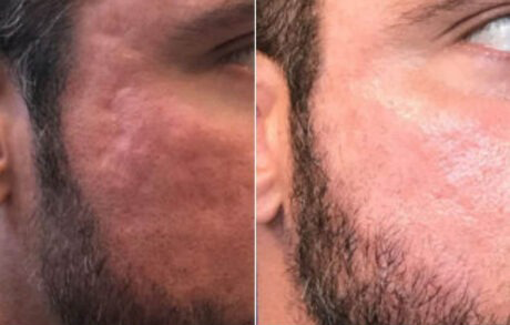 Sculptra® case #71154