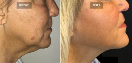 Kybella® case #71141