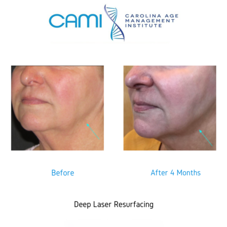 Laser Face Lift case #71158