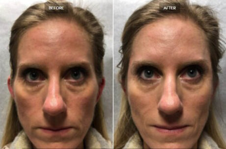 Sculptra® case #71151