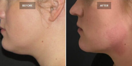 Kybella® case #71136