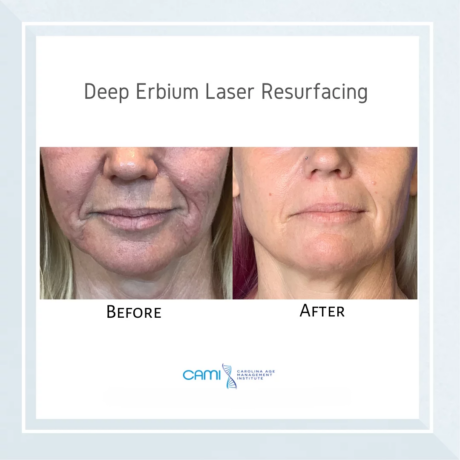 Laser Face Lift case #71155