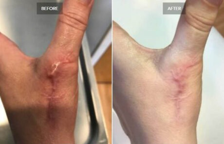 Scar Revision case #71209