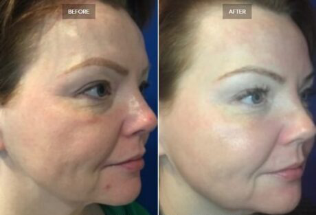 Chemical Peels case #71162