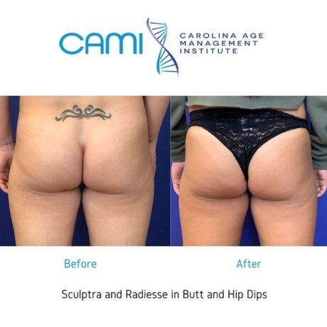 Sculptra® case #71146