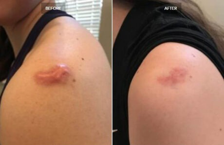 Scar Revision case #71202