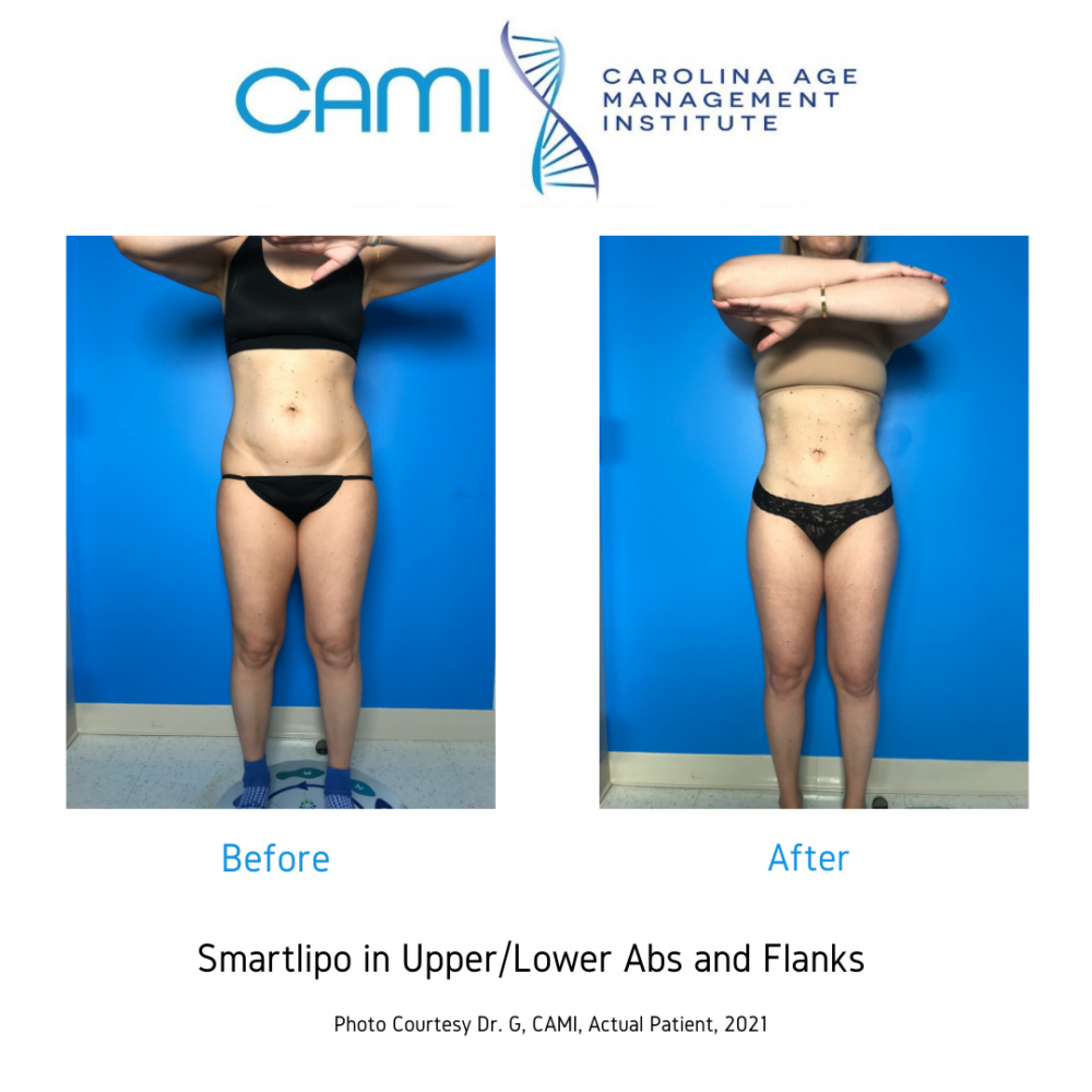 SmartLipo case #71052