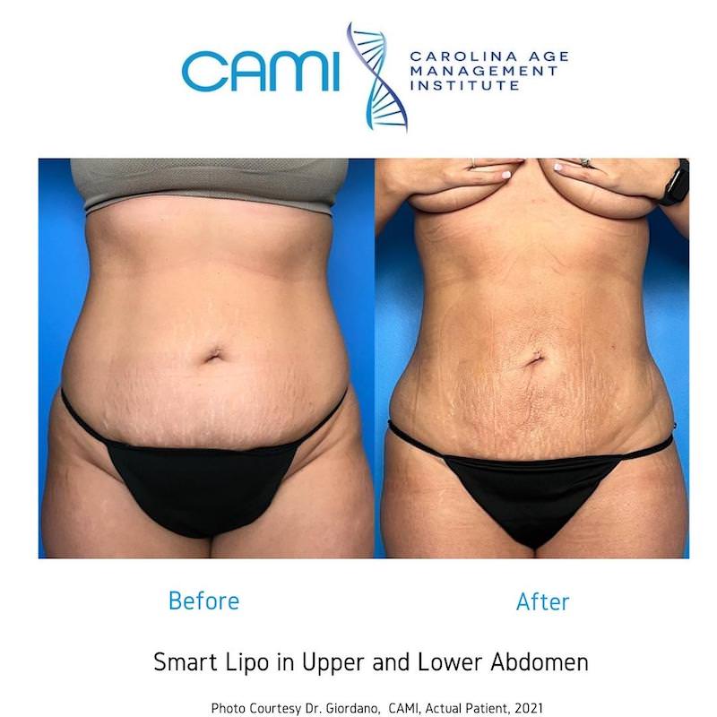 SmartLipo case #71046