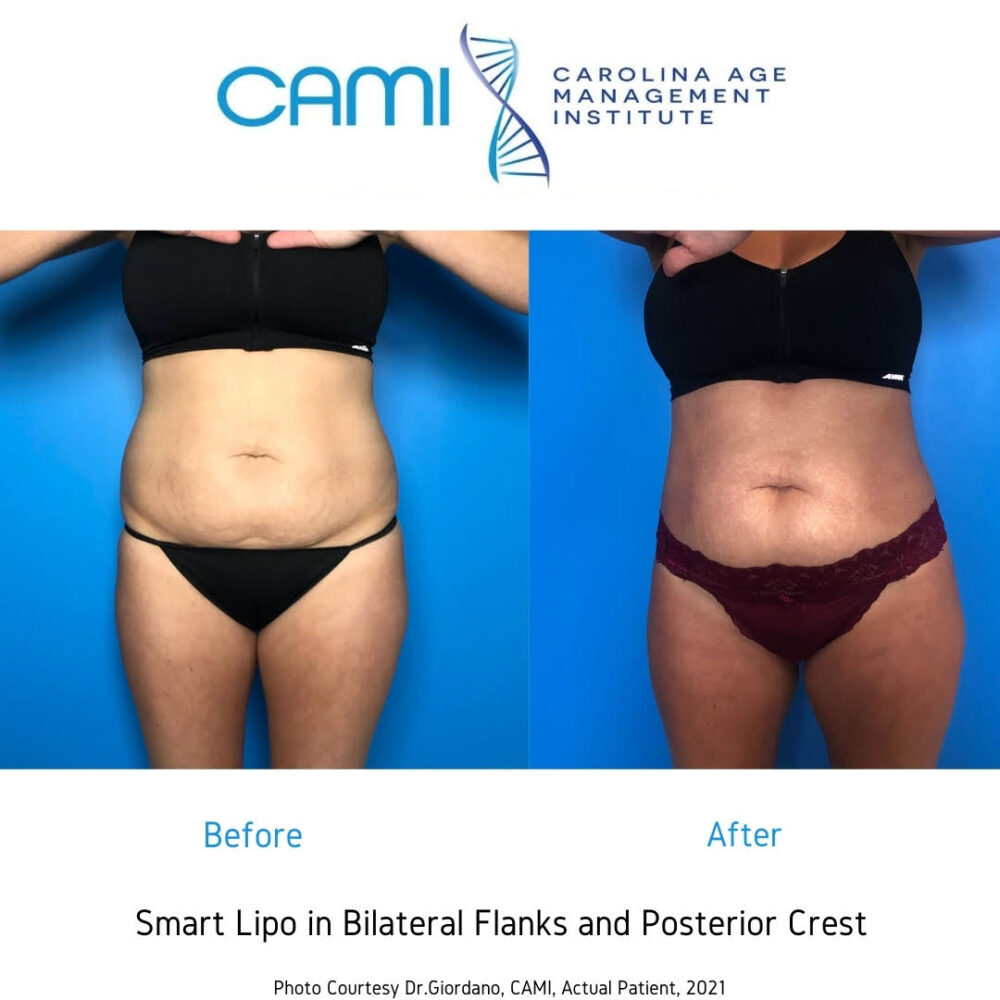 SmartLipo case #71034