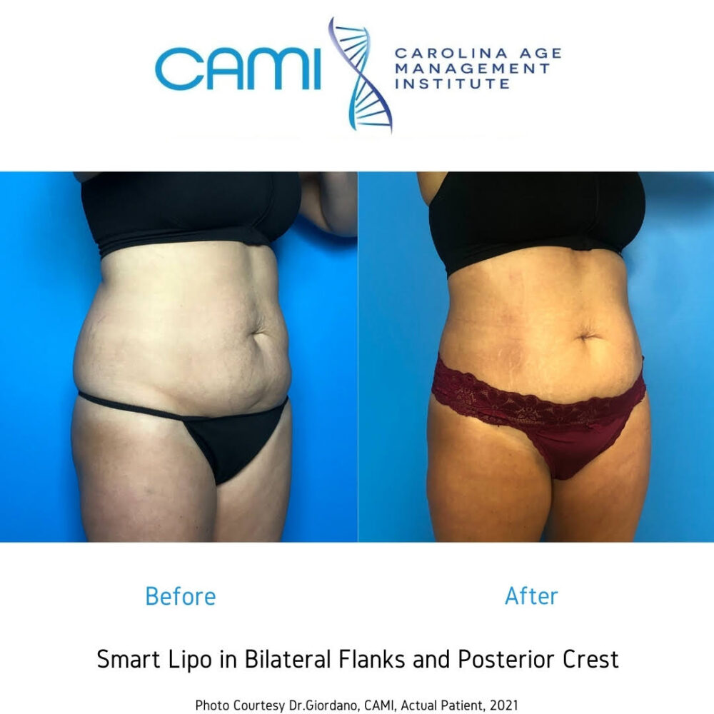 SmartLipo case #71034