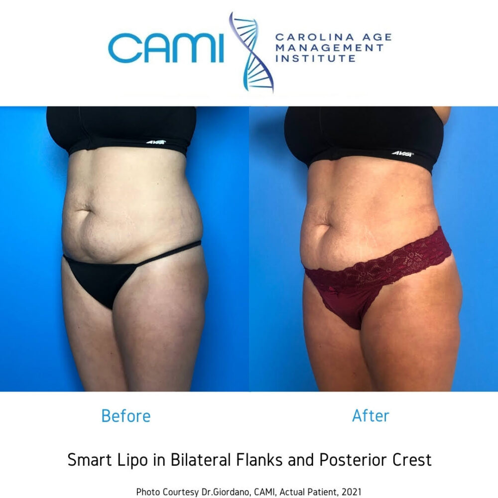 SmartLipo case #71034