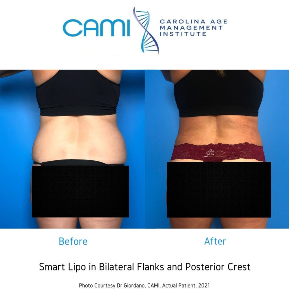 SmartLipo case #71034