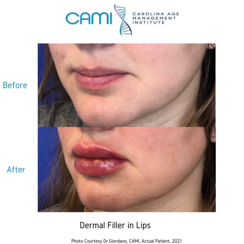 Lip Fillers case #71109