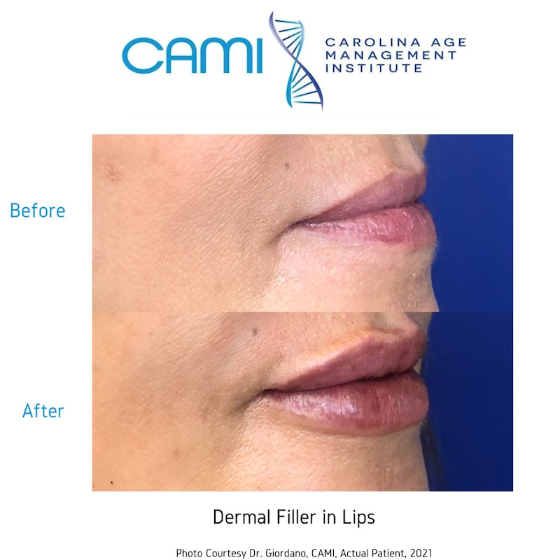 Lip Fillers case #71105