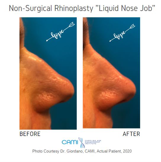 Liquid Rhinoplasty case #71104