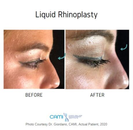 Liquid Rhinoplasty case #71103