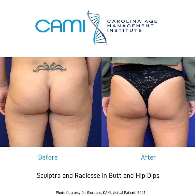 Sculptra® case #71146