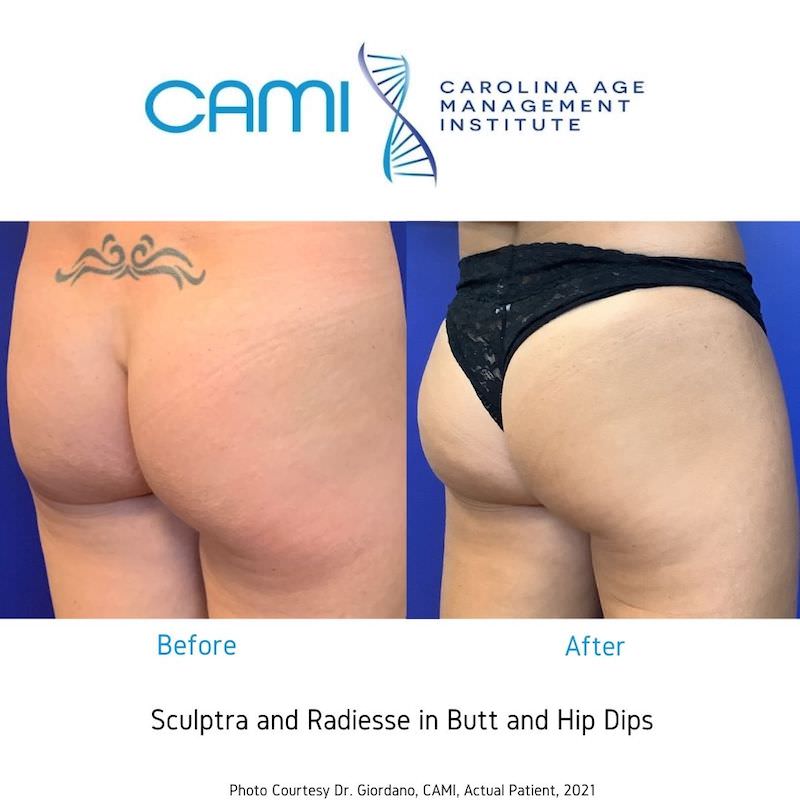 Sculptra® case #71146