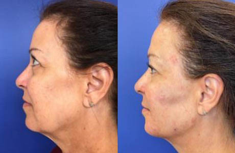 Liquid Facelift case #71724