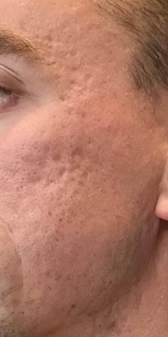 ACNE SCARRING BEFORE/AFTER by dr g – 1