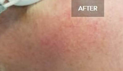 _0001_0000_Laser-Vein-Removal-Patient-2.jpg