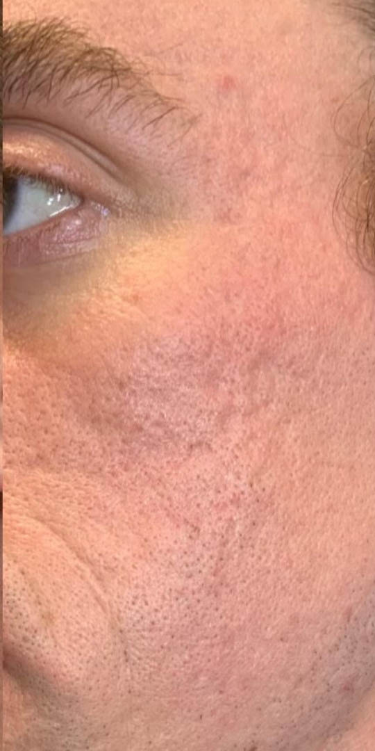 ACNE SCARRING BEFORE/AFTER by dr g – 1