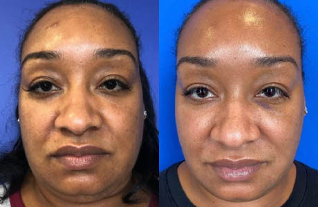 Liquid Facelift case #71727