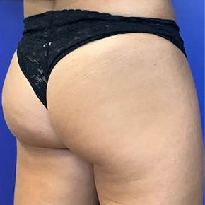 _0001_sculptra-buttock-injections-before-after-photos